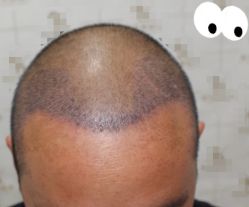 -大麦微针植发丨全国连锁