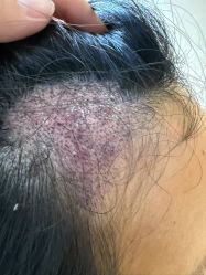 -碧莲盛·不剃发植发