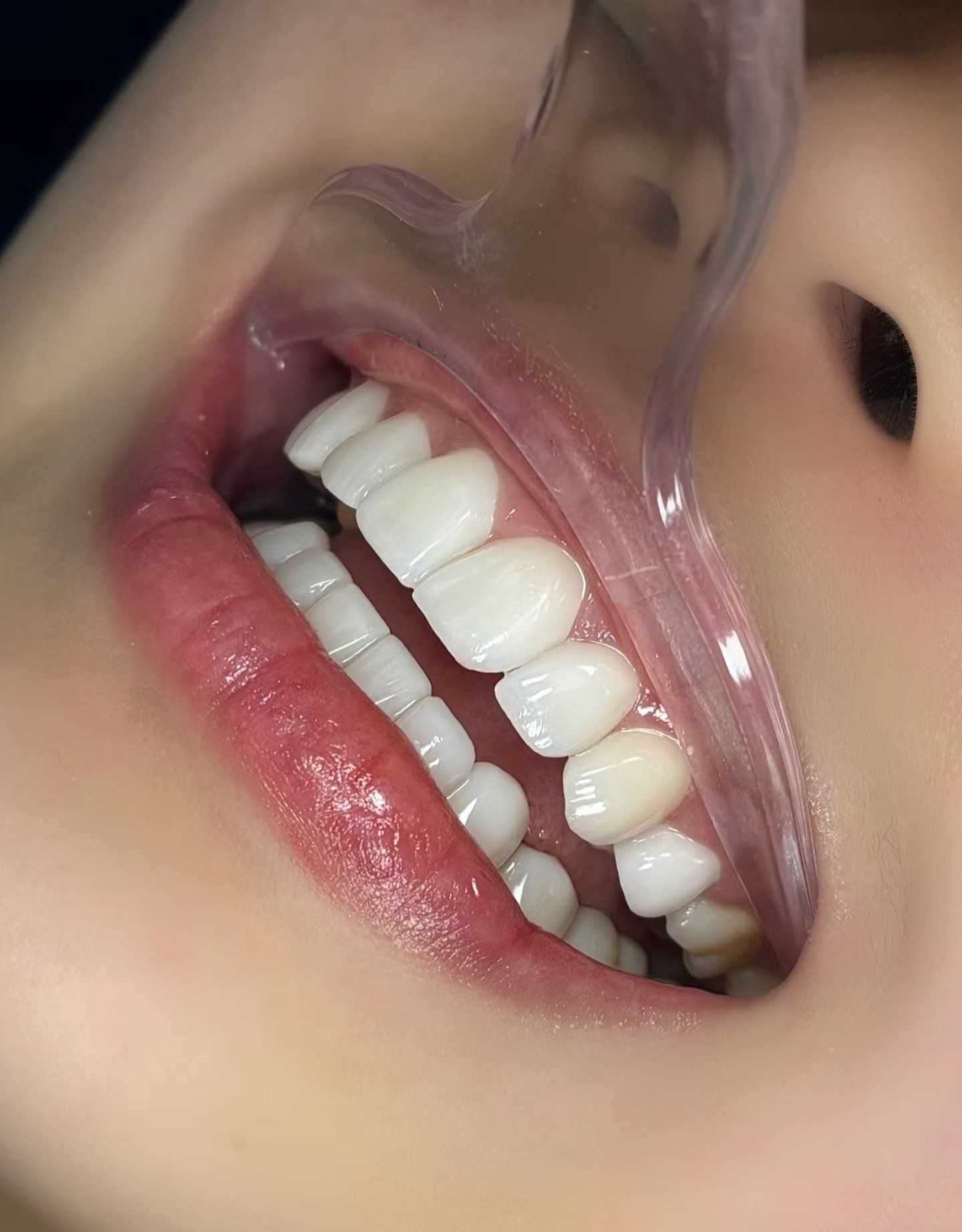 亮白牙齿自然闪耀