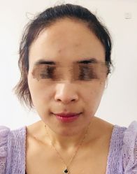 体验前-More摩尔医美の注射线雕光电中心