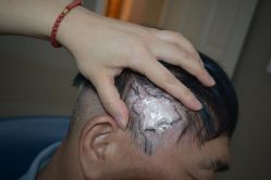 -大麦微针植发全国连锁