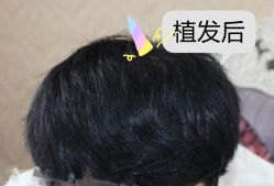 -大麦微针植发全国连锁