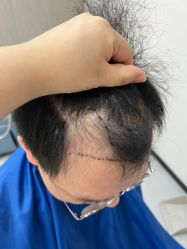 体验前-大麦微针植发全国连锁