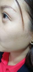 -北京美痣堂古方祛痣斑疣瘊