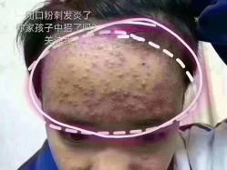 -瑶芳清颜草本祛痘
