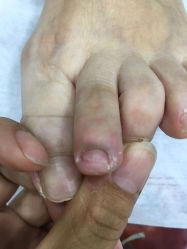 -德哥灰指甲脚气甲沟炎跖疣护理