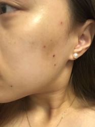 -爱莎扁平疣·汗管瘤·斑痣中心