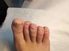 -世龙世家灰指甲鸡眼脚气甲沟炎跖疣护理(通州店)