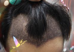 -大麦微针植发全国连锁