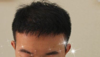 -大麦微针植发全国连锁