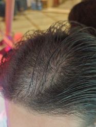 -碧莲盛·不剃发植发