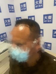 -大麦微针植发丨全国连锁
