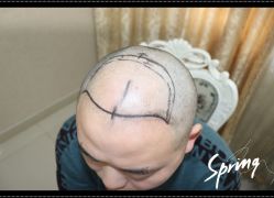 -大麦微针植发全国连锁