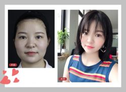 点击看大图 体验后-广东韩妃整形外科医院