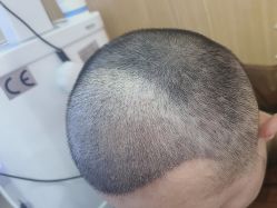 -雍禾植发