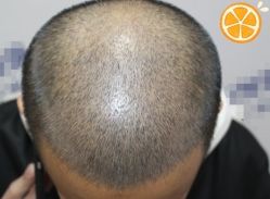 -大麦微针植发丨全国连锁