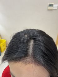 -大麦微针植发丨全国连锁