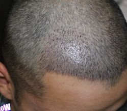 -大麦微针植发丨全国连锁