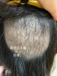 点击看大图 体验后-大麦微针植发全国连锁