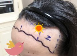 -大麦微针植发全国连锁