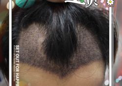 -大麦微针植发全国连锁