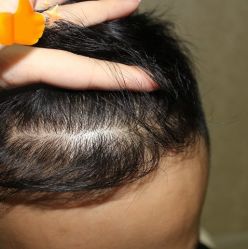 -大麦微针植发丨全国连锁