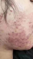 -瑶芳清颜草本祛痘