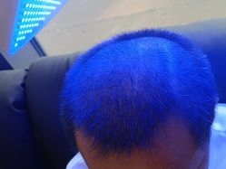 -碧莲盛·不剃发植发