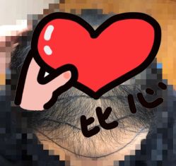 -大麦微针植发全国连锁