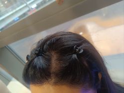 -碧莲盛·不剃发植发