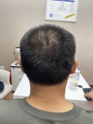 -大麦微针植发全国连锁