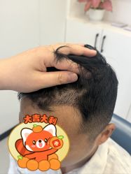 -大麦微针植发全国连锁