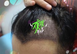 -大麦微针植发全国连锁