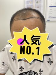 体验前-大麦微针植发全国连锁