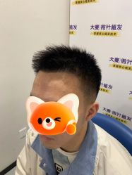 体验后-大麦微针植发全国连锁