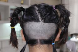 点击看大图 -大麦微针植发丨全国连锁