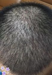 -大麦微针植发丨全国连锁