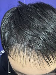 -碧莲盛·不剃发植发