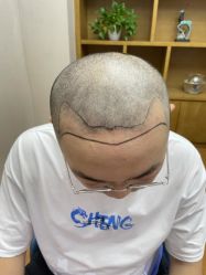 -大麦微针植发全国连锁