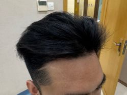 -大麦微针植发丨全国连锁