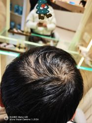 -碧莲盛·脱发养发中心