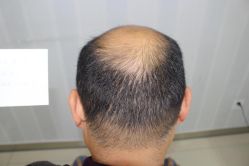 -大麦微针植发丨全国连锁