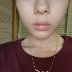 点击看大图 体验后-Yestar 嘉兴艺星医疗美容医院