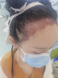 -大麦微针植发全国连锁