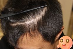 -大麦微针植发丨全国连锁