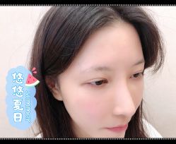 点击看大图 体验后-大麦微针植发全国连锁