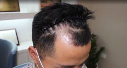 体验前-大麦微针植发全国连锁