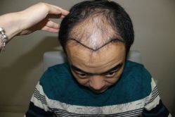 -大麦微针植发全国连锁