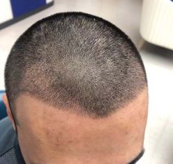 -大麦微针植发全国连锁