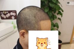 -大麦微针植发丨全国连锁